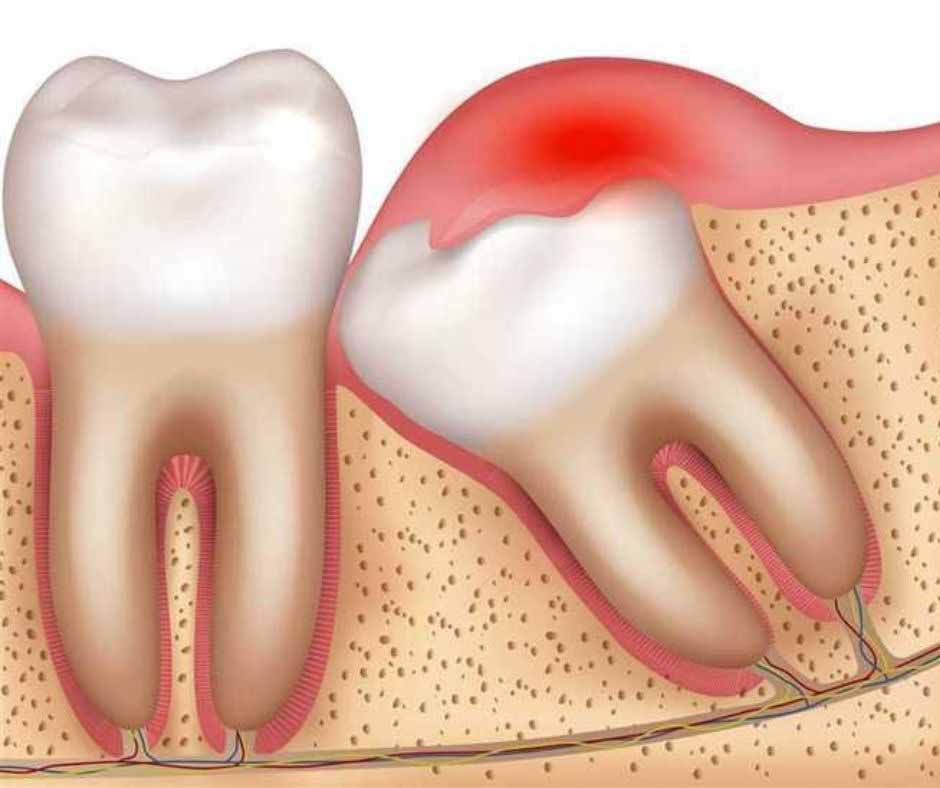 Impacted Wisdom Tooth Melbourne